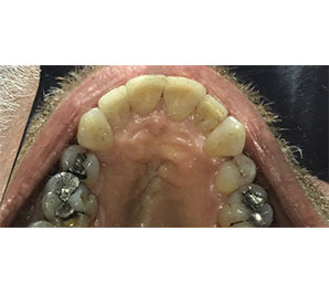 Invisalign and Bonding - After