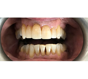 Invisalign and Bonding - After