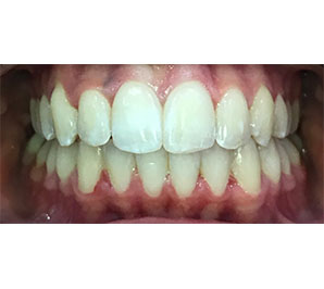 Invisalign and Tooth Whitening - After