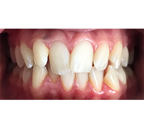 Invisalign and Tooth Whitening - Before